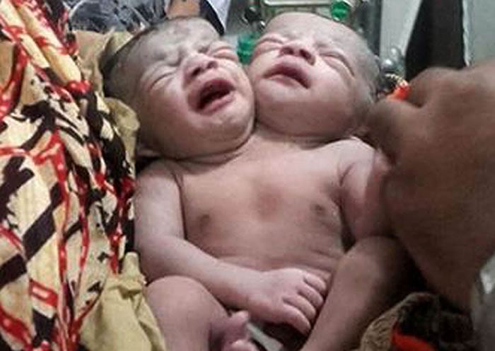 孟加拉诞生极为罕见的“双头女婴” 数千村民跑到医院朝圣