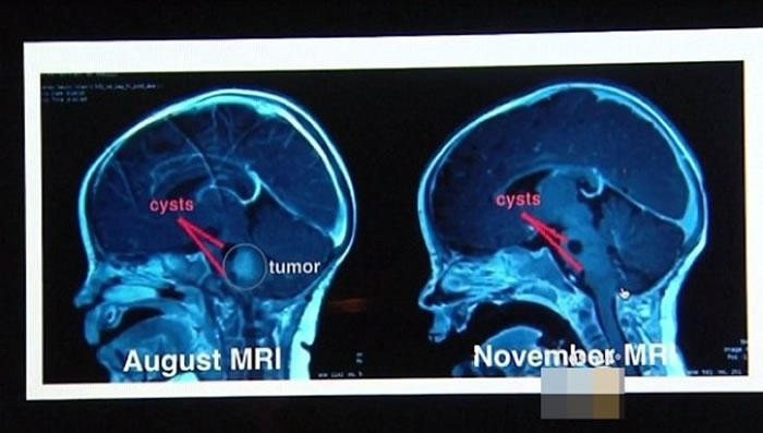 左图为8月时的脑扫描结果,右图为11月的。可见肿瘤(红圈示)大幅缩小。