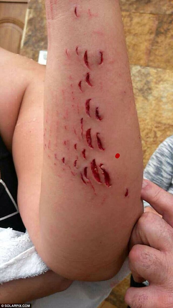 惊悚：西班牙女子遭鲨鱼啃食 左手臂留下数十个凹痕