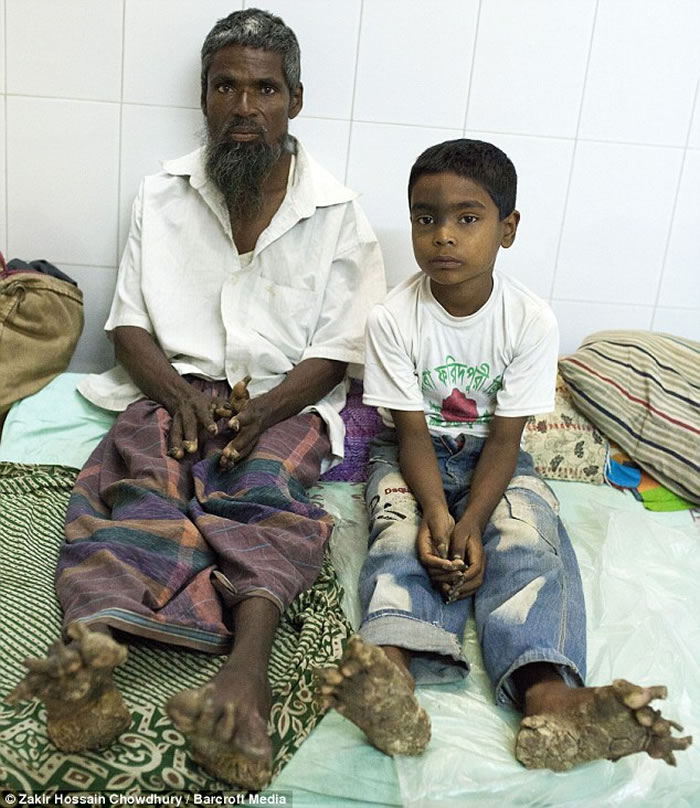 孟加拉再现“树人” 一家三男手脚长满疣