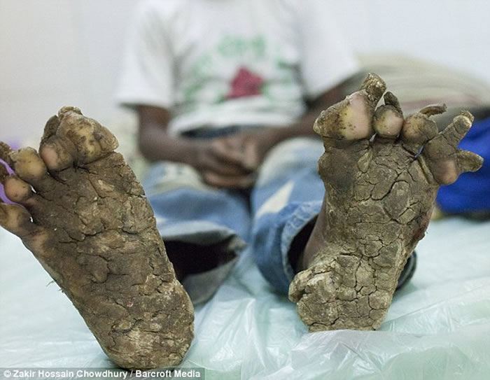 孟加拉再现“树人” 一家三男手脚长满疣