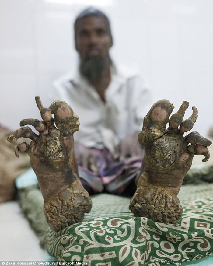 孟加拉再现“树人” 一家三男手脚长满疣