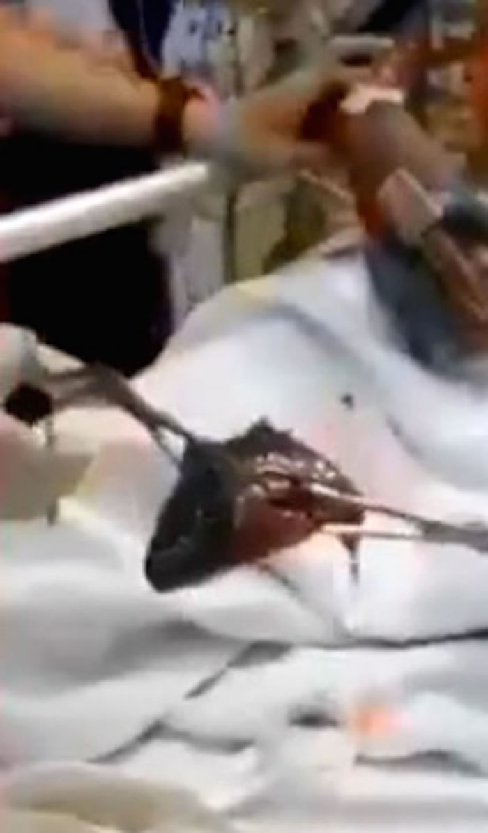 马来西亚男子异物卡喉 最后医生从喉咙拉出一条仍在挣扎的活鱼“攀鲈”