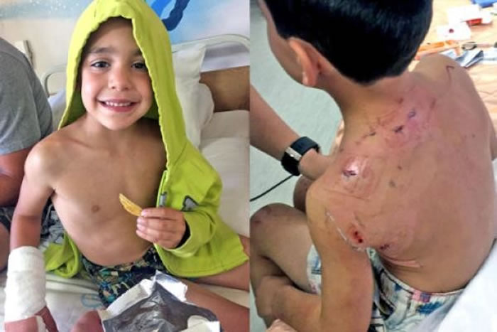 男孩丹尼的脖子、手臂和肩膀都被咬伤,所幸没有生命危险。