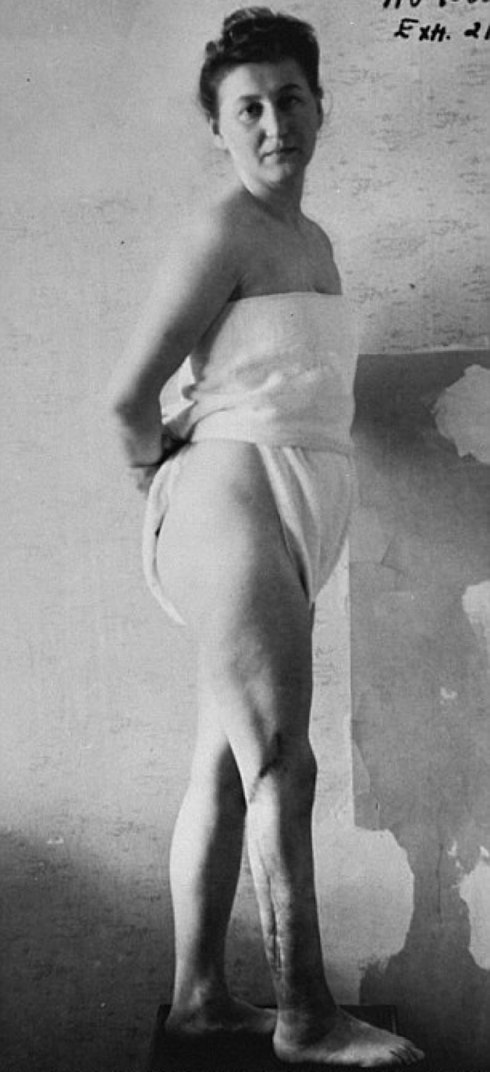 其中一名受害者,展示其永远无法磨灭的伤疤。