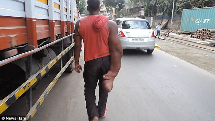印度男子患"局部巨人症"右臂重20公斤 被称魔鬼的孩子