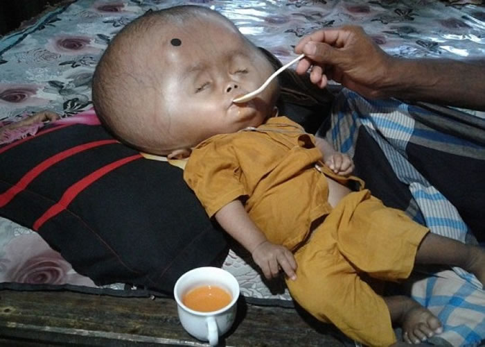 埃蒙完全丧失活动和学习能力,需要父母无时无刻照顾。