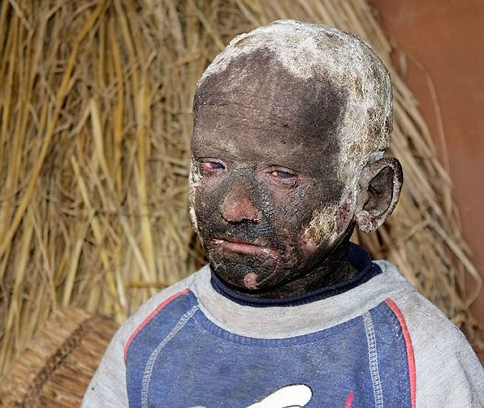 尼泊尔男童患鱼鳞癣 不能说话行走如石头人 -