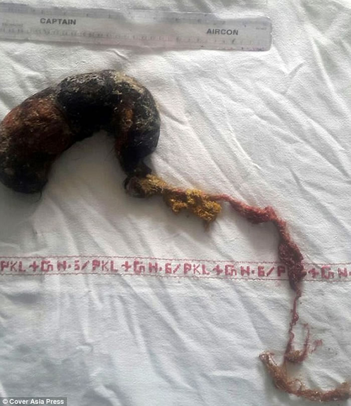 ӡ�ȸ�Ů�����������ۺ�֢����ͷ��20�� θ��ȡ��3����ë��