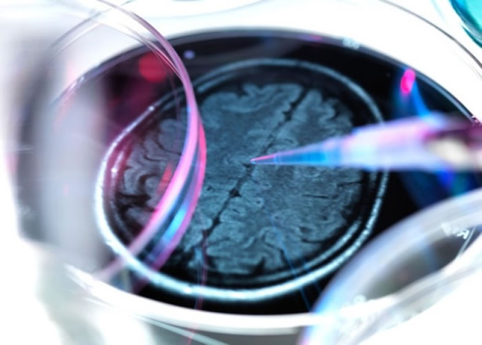 ��Ч����²����� ����֪�ϰ�֢��ҩ��Aducanumab��������