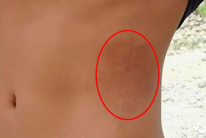 小明称,看到亮光后,身体开始发痒,刮得身上有点红。