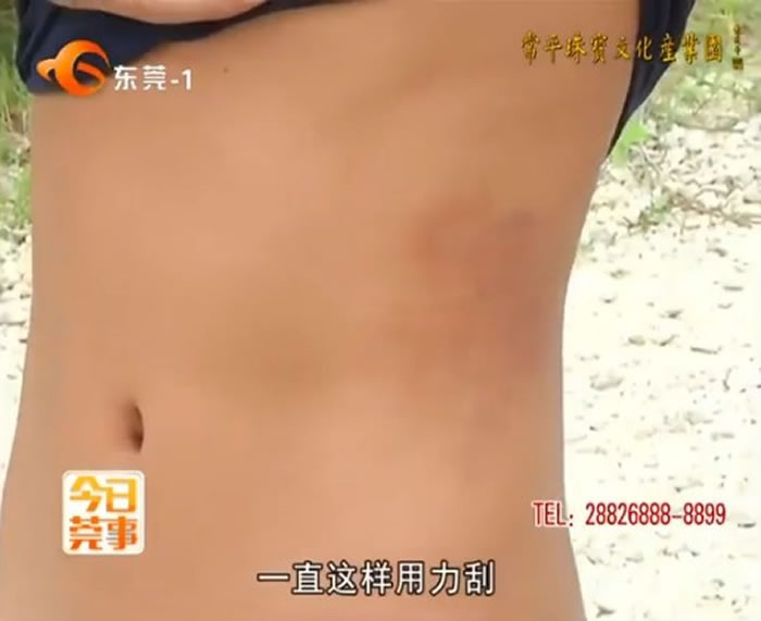 农庄员工觉得身体很痒,一直用力抓,抓出红色痕迹。