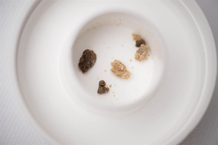 美国研究指坐云霄飞车可帮助排除小型肾脏结石