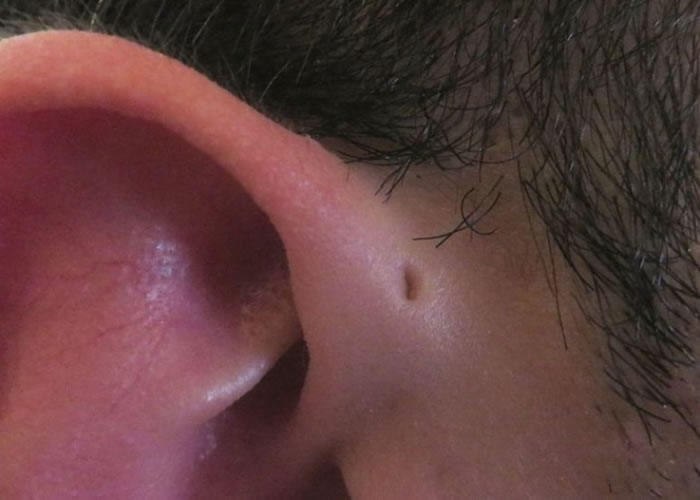 部分亚洲人耳边位置有个洞 “耳前窦”可能是进化残留物