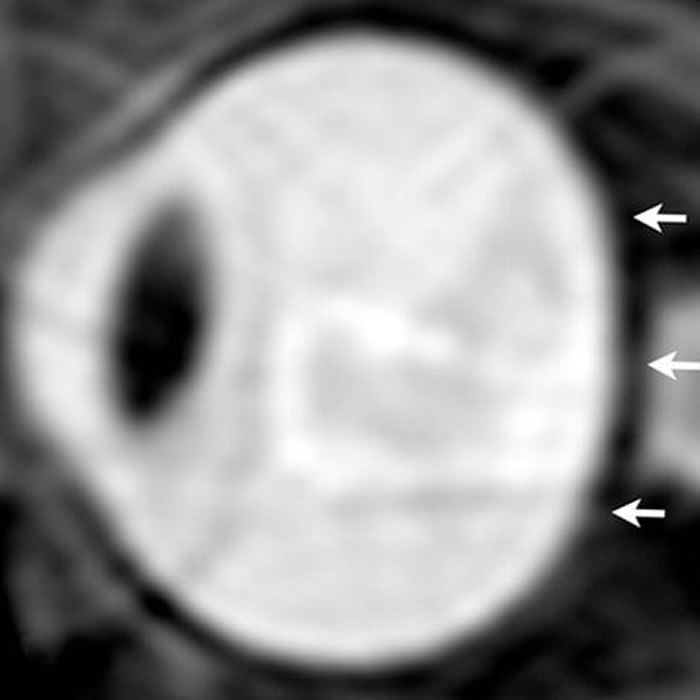 太空人眼部的核磁共振图。在长期的太空生活之后,太空人的眼球出现被挤压扁平的状况。 PHOTOGRAPH BY RSNA