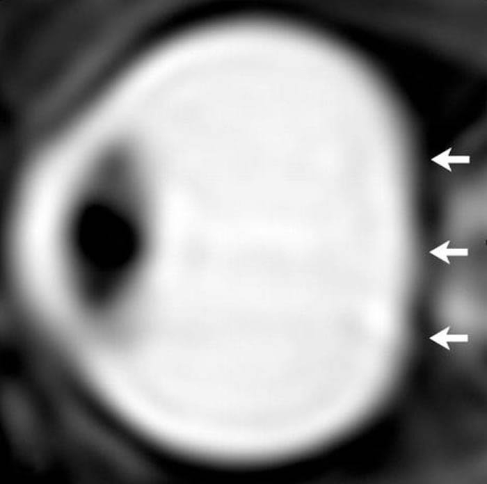 太空人眼部的核磁共振图。在长期的太空生活之后,太空人的眼球出现被挤压扁平的状况。 PHOTOGRAPH BY RSNA
