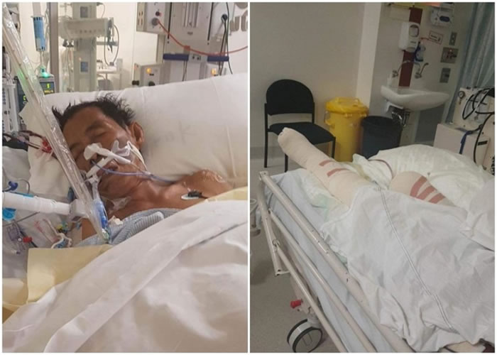 帕雷雅(左图)的右脚被截走(右图),左脚其后亦要截肢。