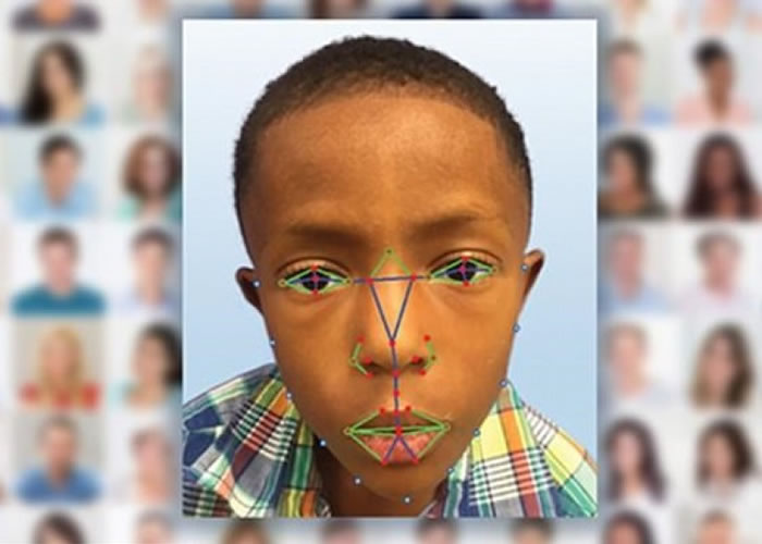 脸部侦测技术软件可辨别出罕有遗传病。