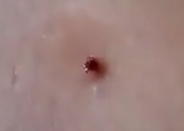 蜱虫冒出后,仍活生生地爬来爬去。