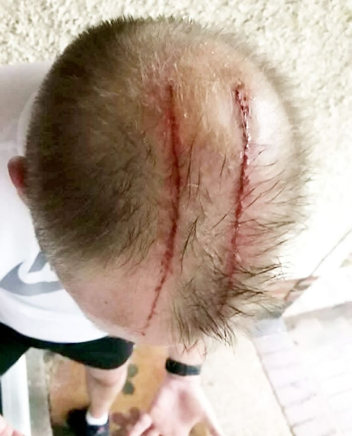 英国德比郡男子惨遭栗翅鹰“鹰爪功” 头顶鲜血直流