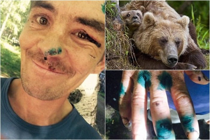 罗普希恩(左)入森林摘菇遭熊袭,全身重创。