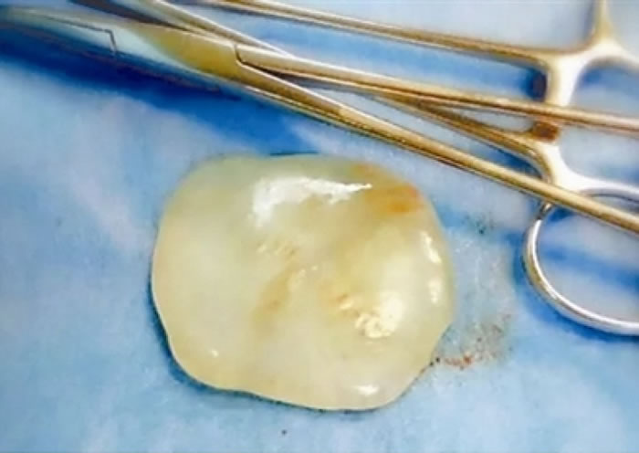 “假宝玉”?浙江台州天台县产妇剖腹产子滑出一块“玉” 原来是“腹腔内游离体”