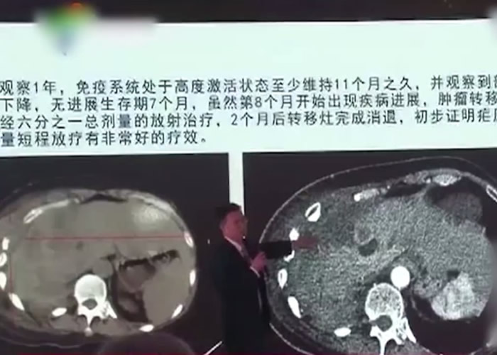 陈小平教授分享其研究成果,显示利用疟疾原虫免疫系统疗法可有效治疗癌症。