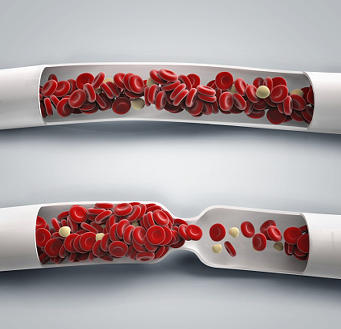 Mayo Clinic的研究显示新的口服血液稀释药物具有较低的肾脏风险