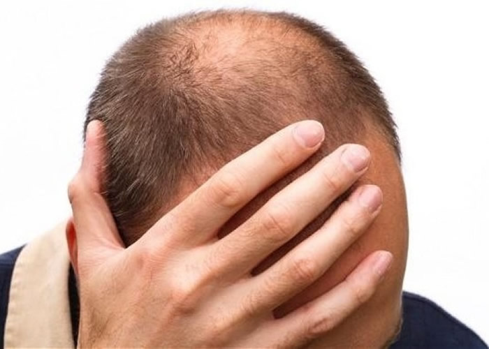 脱发问题尤其困扰踏入中年的男士。