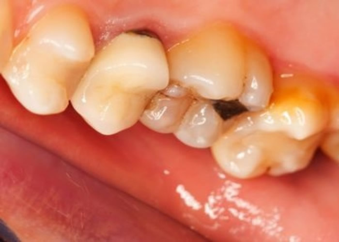 进餐时饮用带酸性饮料,均会磨损牙齿并会捐害牙齿的珐琅质。(资料图片)