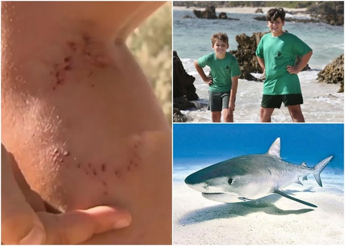 男童腿部遭神秘生物咬伤。