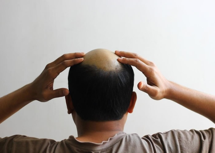 科学家发现部分现存药物的成分,有助头发生长。(资料图片)