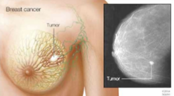 《临床研究杂志》:用于治疗血癌的药物可能对治疗三阴性乳腺癌也有效果
