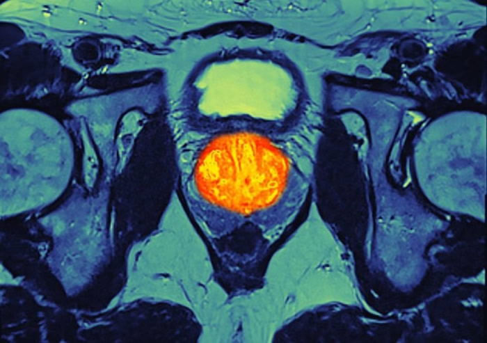 英国医疗专家着手研究新型免疫治疗药物 可有助舒缓末期前列腺癌病情