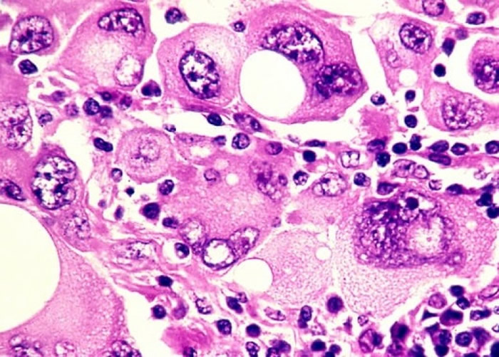 Ƥ��������ͻ�� ���޿�ѧ���к�ɫ����ѪҺ����