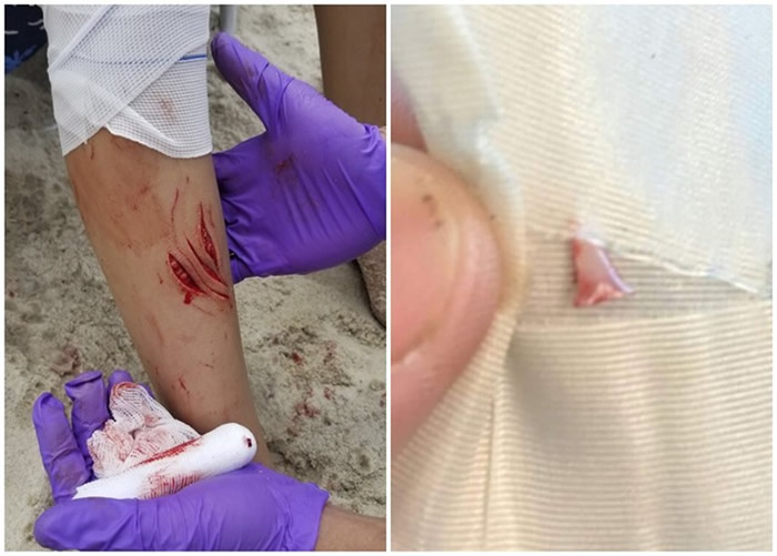 救护员为女童治理腿部被鲨鱼咬的伤口(左图),并在男童腿部拔出一只鲨鱼牙。