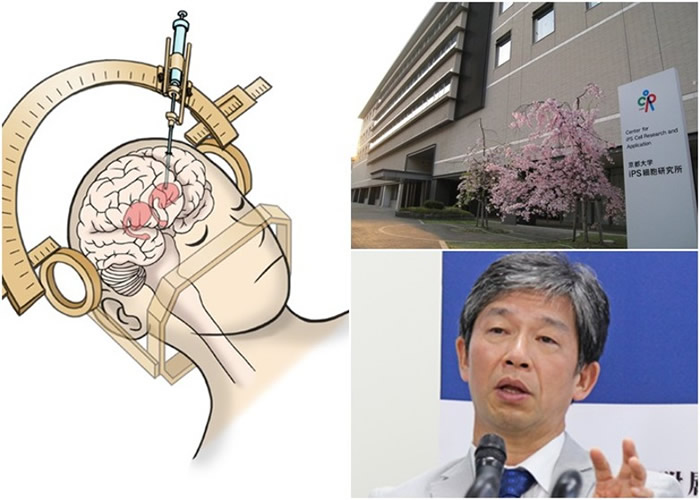 研究员以iPS细胞制成的神经元细胞,注射入柏金逊症患者的脑内。