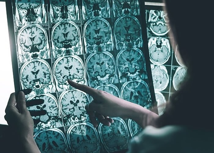 专家成功找出病因,并发现一种新方法可治疗老人痴呆。