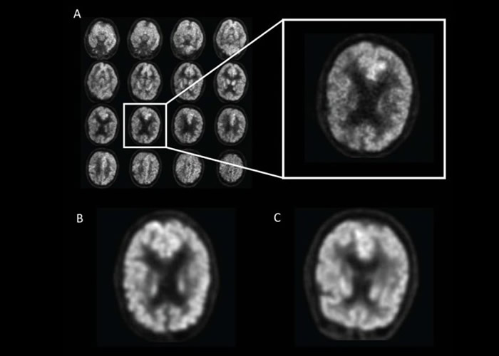 研究人员让AI学习深度运算法检测脑图像,及早发现早老性痴呆症病征。