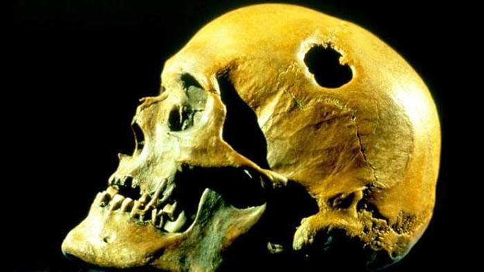 颅骨穿孔术：史前人类为什么要在头骨上钻孔？
