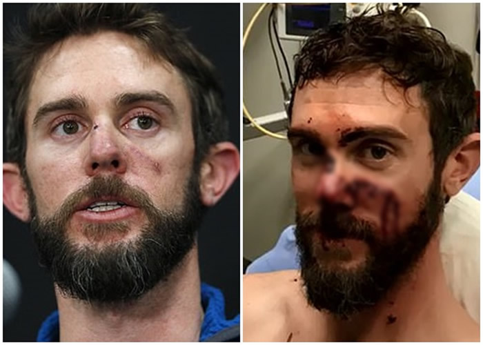 考夫曼脸颊上仍留有一条深长伤疤。