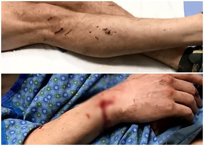 考夫曼全身多处被抓伤。