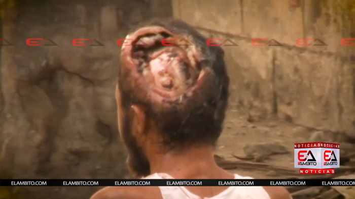 Ӭ���������ױ������˺�ͷ����4000���������ɵ�ͷ����¶