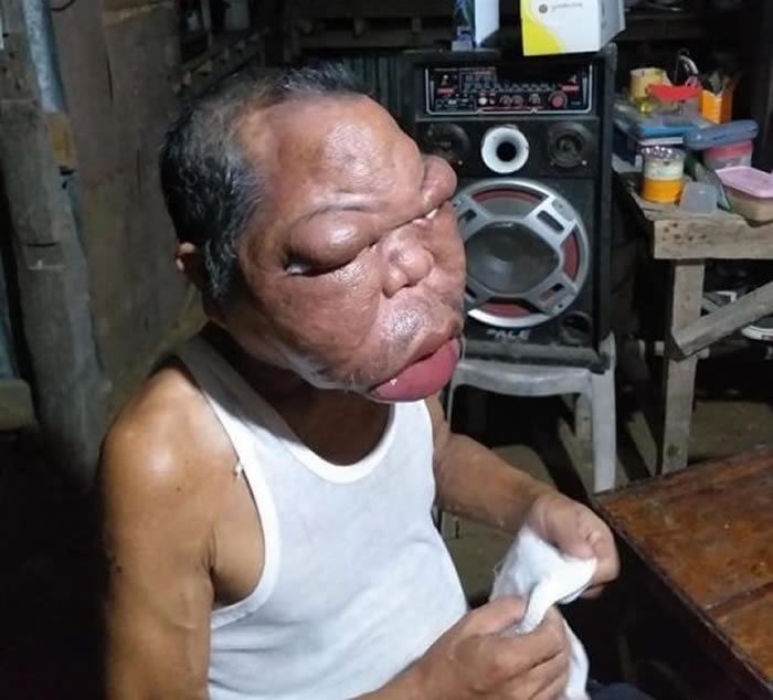 菲律宾莱特岛男子得了不明疾病 脸肿成以前的三倍