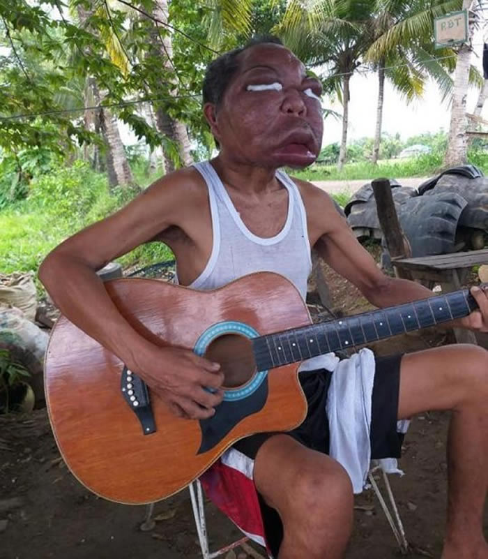 菲律宾莱特岛男子得了不明疾病 脸肿成以前的三倍