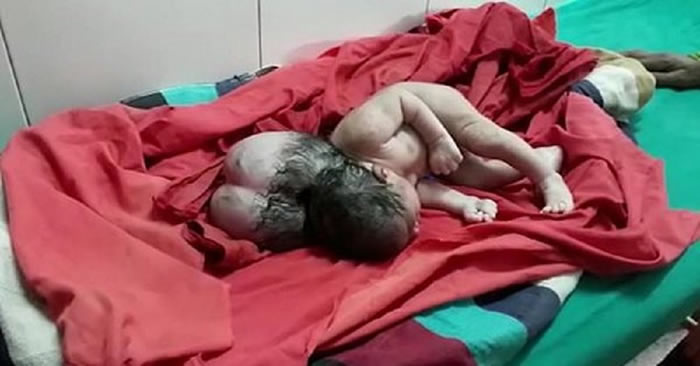 印度北方邦伊塔自治区一名妇女生下“三头女婴”