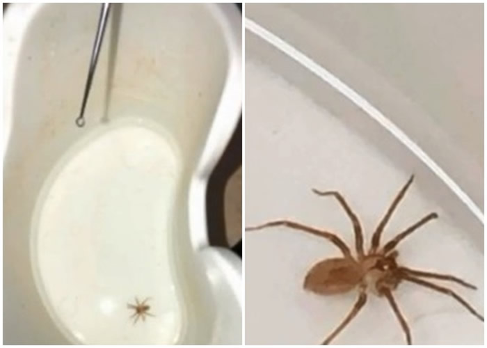 美国密苏里州堪萨斯城女子突感耳朵不适疼痛 医生发现棕色隐士蜘蛛