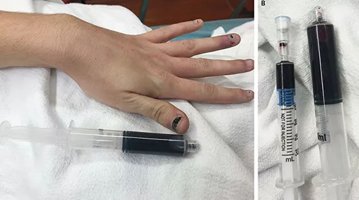 ����Ѫ�쵰��Ѫ֢������һ��Ů���ڷ�������ֹʹҩ��ѪҺ�����ɫ