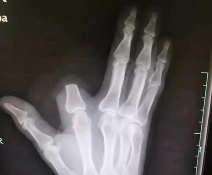 �㽭������������ũ�񿳲񱻶���ҧ�˺��е��Լ�����ָ