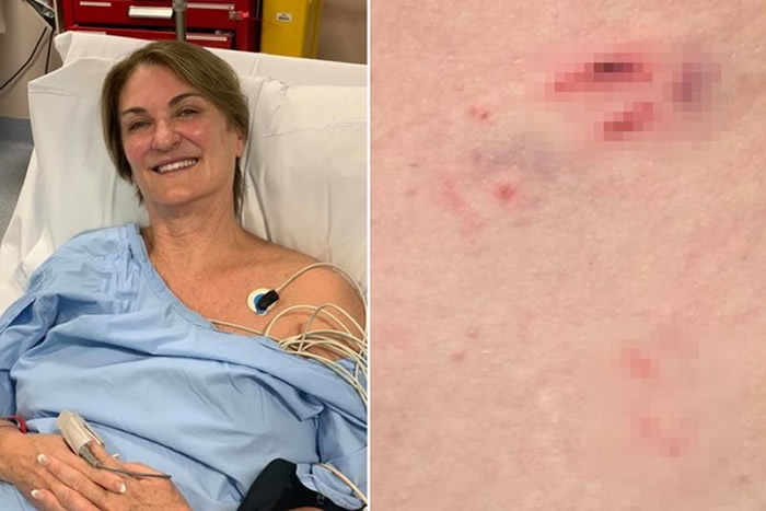 澳洲女子好奇观赏剧毒“虎蛇”交配被咬4口 医生认为“存活机率为零”但最后活了下来